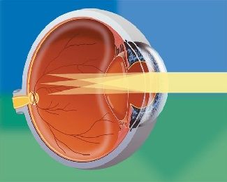 diagram of how astigmatism affects the eye