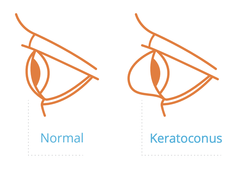 Normal versus Keratoconus eye